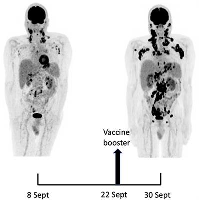 Rapid Progression of Angioimmunoblastic T Cell Lymphoma Following BNT162b2 mRNA Vaccine Booster Shot: A Case Report